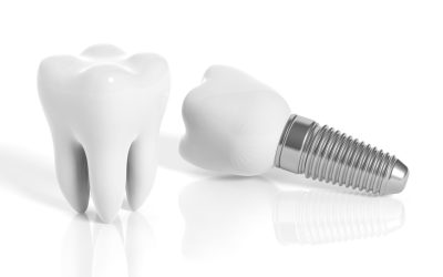 ¿Qué debemos saber sobre los implantes dentales?