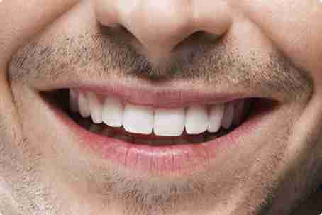 Beneficios - Sonrisa natural y estética