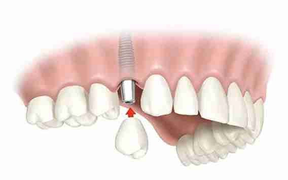 Tratamientos - Implantes Individuales y Puentes