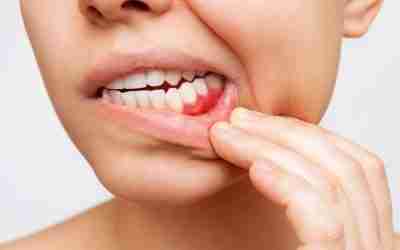 How to solve bleeding gums?