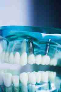 dental implant
