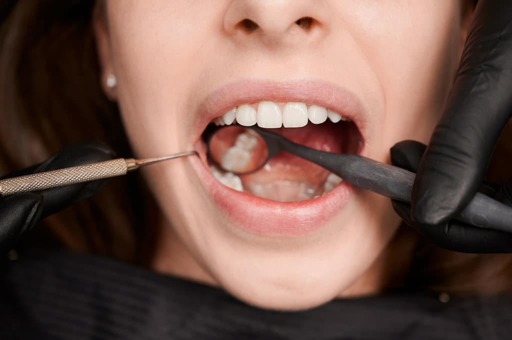 Replacing old dental fillings